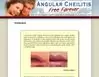 Gallery - Angular Cheilitis Free Forever Review