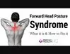Gallery - Forward Head Posture Fix Review