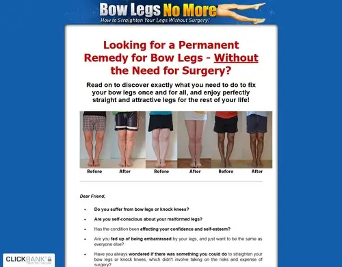 Bow Legs No More