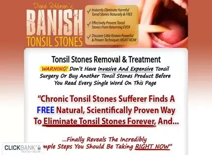 Banish Tonsil Stones Banish Tonsil Stones